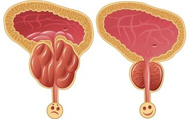 Wie Prostalix bei Prostatitis vor und nach der Behandlung wirkt