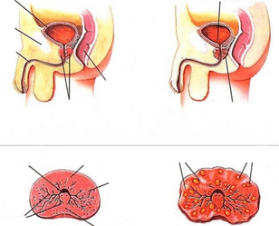 normale Prostata und chronische Prostatitis
