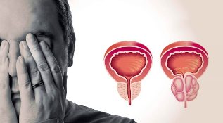 Gesunde und entzündete Prostata