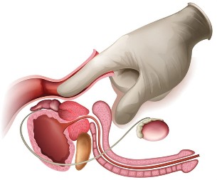Prostata-Massage