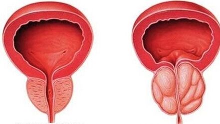 normale und geschwollene Prostata