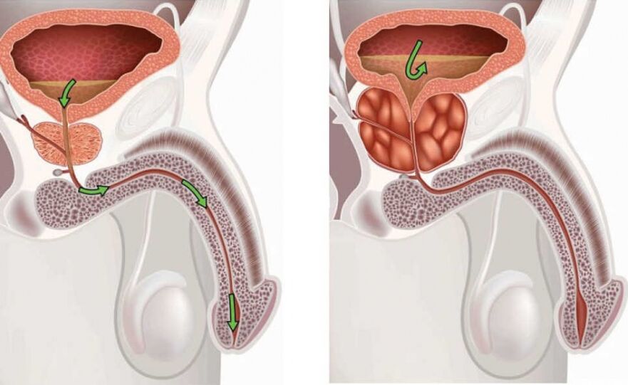 gesunde und kranke Prostata bei Männern
