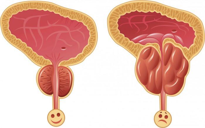 gesunde und entzündete Prostata mit Prostatitis