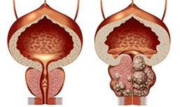 Gesunde und ungesunde Prostata