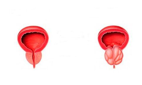 gesunde und entzündete Prostata mit Prostatitis